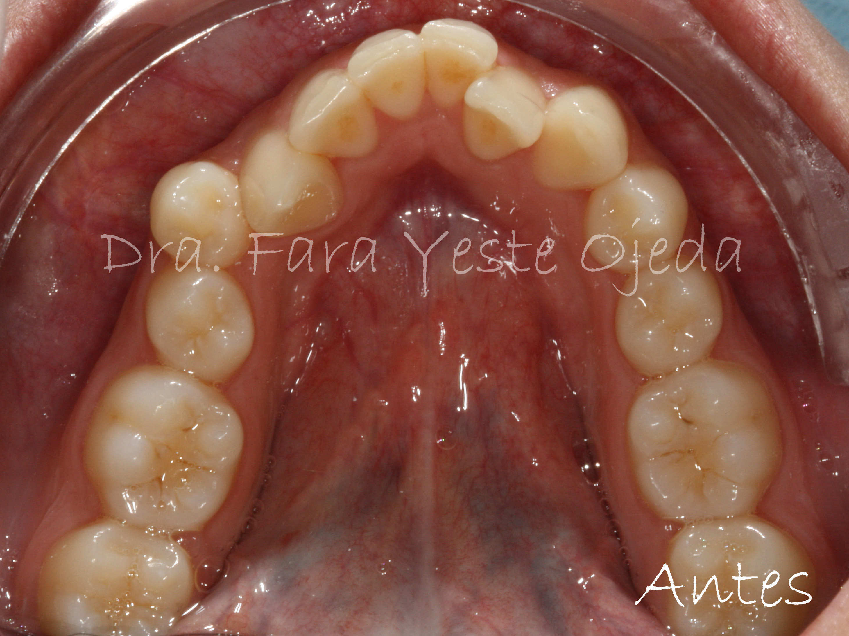 Ortodoncia Apiñamiento 3 (Antes)-